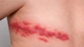 Cảnh báo nguy cơ gia tăng bệnh zona ở người có bệnh mạn tính