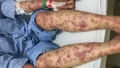 Nguy kịch vì dùng thuốc giảm cân, collagen không rõ nguồn gốc