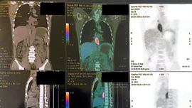 Nuốt nghẹn, sụt 5 kg, đi khám phát hiện mắc hai loại ung thư