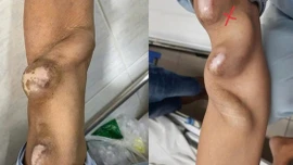 Cảnh báo suy thận ở người trẻ