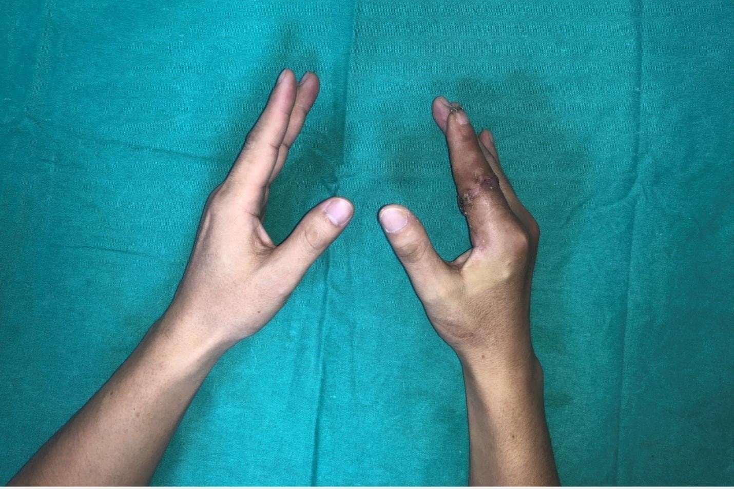 Operace byla úspěšná a prst byl po 25 hodinách znovu připevněn. Foto: BVCC Ca phẫu thuật diễn ra thành công với ngón tay được nối liền sau 25 giờ. Ảnh: BVCC