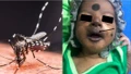 Chikungunya từng khiến bé sơ sinh mặt tím đen, phải nhập viện cấp cứu khẩn cấp