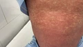 Bộ Y tế: Người dân tuyệt đối không mua, bán hoặc sử dụng các thuốc chứa Phenylbutazone