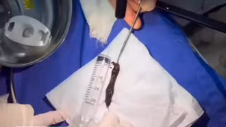 Bệnh viện Đa khoa Hưng Thịnh gắp đỉa dài 8 cm trong khí quản 1 thanh niên