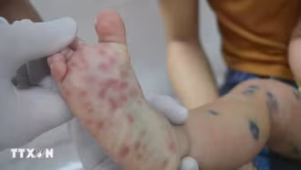 Thành phố Hồ Chí Minh ghi nhận 3 ca tử vong do tay chân miệng đầu tiên năm 2026