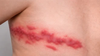 Cảnh báo nguy cơ gia tăng bệnh zona ở người có bệnh mạn tính