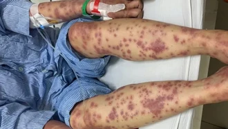 Nguy kịch vì dùng thuốc giảm cân, collagen không rõ nguồn gốc