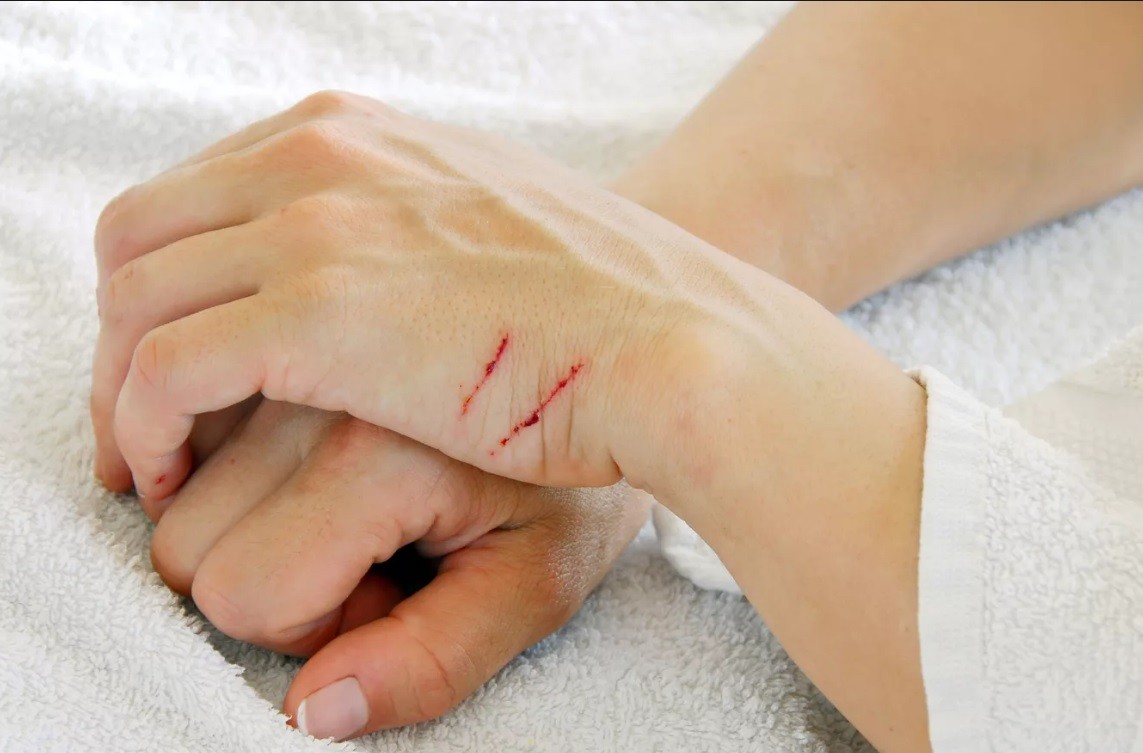Phát kiến mới hứa hẹn thay đổi điều trị chấn thương, giảm viêm, chống nhiễm trùng và hỗ trợ hồi phục nhanh. vet-thuong.jpg