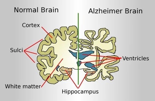 Bộ não của người mắc Alzheimer và của người bình thường. 12-7-alzheimer-9757.jpg