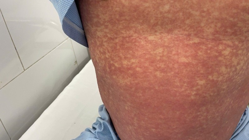 Hình ảnh người bệnh bị dị ứng với thuốc Phenylbutazone. thuoc-cam-4279.jpg