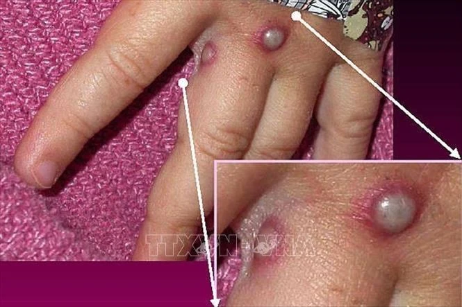 Bàn tay của bệnh nhân mắc đậu mùa khỉ. Ảnh tư liệu: Getty Images/TTXVN