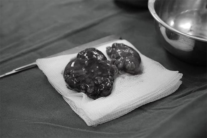 Loại bỏ thành công khối u tuyến nước bọt khổng lồ đeo đẳng người phụ nữ 60 tuổi ảnh 1