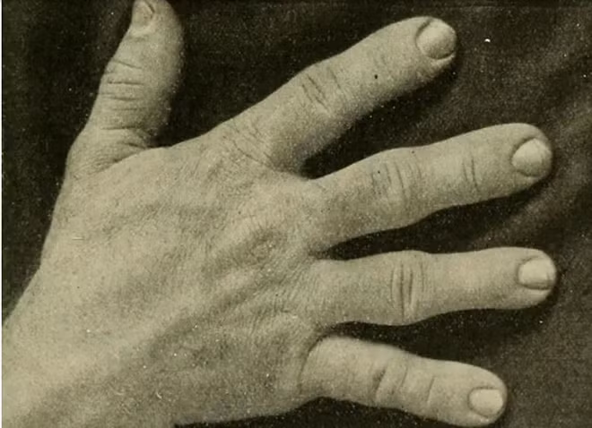 Người duy nhất trên thế giới từ người lùn hóa thành khổng lồ ảnh 2