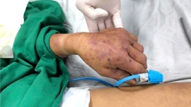 Hà Nội ghi nhận ca đầu tiên tử vong vì mắc liên cầu lợn