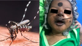 Chikungunya từng khiến bé sơ sinh mặt tím đen, phải nhập viện cấp cứu khẩn cấp