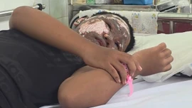 Chơi pháo nổ, bé trai bị tai nạn cháy đen khuôn mặt