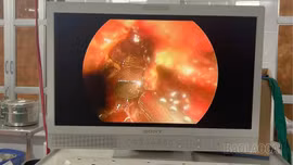 Bệnh viện Đa khoa số 3 tỉnh Lào Cai: Cấp cứu thành công bệnh nhi bị mảnh kính đâm thủng ruột