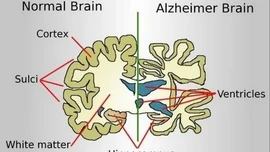 Trung Quốc đình chỉ phương pháp phẫu thuật điều trị Alzheimer phổ biến