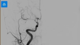 Cảnh báo đột quỵ não ở trẻ: Ca bệnh đánh thức sự chủ quan