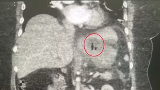 Suýt mất mạng vì xương cá đâm thủng dạ dày