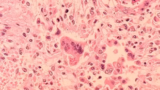 Trẻ tử vong do biến chứng sởi hiếm gặp tại Los Angeles (Mỹ)