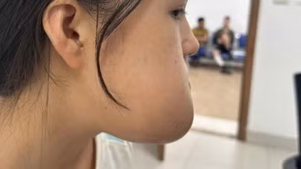 Phẫu thuật loại bỏ khối u, lấy lại thẩm mỹ khuôn mặt cho cô gái 16 tuổi