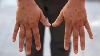 Anh ghi nhận ca đầu tiên nhiễm chủng mới của virus đậu mùa khỉ