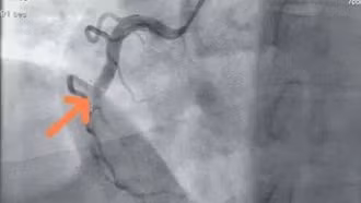 Nhồi máu cơ tim trẻ hóa: Người 30 tuổi cũng có thể gục ngã bất ngờ