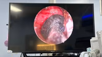 Phát hiện nấm xoang bướm sau nhiều tháng đau đầu âm ỉ