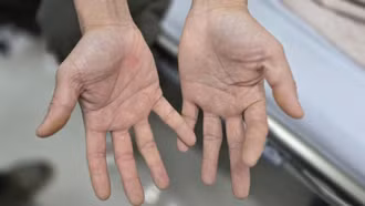 Nguy hiểm từ bóng cười: Liệt nửa người do ngộ độc khí N₂O