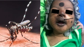 Chikungunya từng khiến bé sơ sinh mặt tím đen, phải nhập viện cấp cứu khẩn cấp