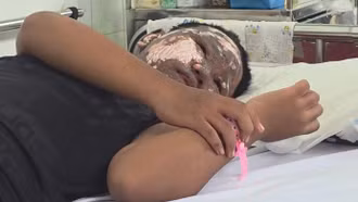 Chơi pháo nổ, bé trai bị tai nạn cháy đen khuôn mặt