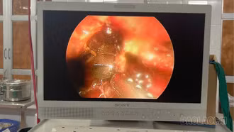 Bệnh viện Đa khoa số 3 tỉnh Lào Cai: Cấp cứu thành công bệnh nhi bị mảnh kính đâm thủng ruột