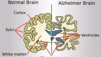 Trung Quốc đình chỉ phương pháp phẫu thuật điều trị Alzheimer phổ biến