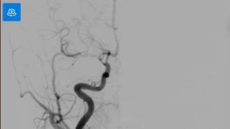 Cảnh báo đột quỵ não ở trẻ: Ca bệnh đánh thức sự chủ quan