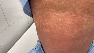 Bộ Y tế: Người dân tuyệt đối không mua, bán hoặc sử dụng các thuốc chứa Phenylbutazone