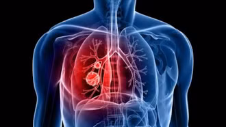 Tình trạng viêm có thể gây khởi phát ung thư phổi ở giai đoạn sớm