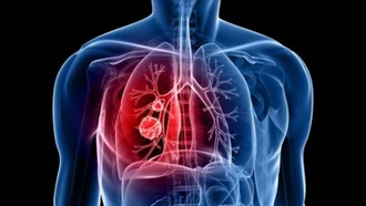 Tình trạng viêm có thể gây khởi phát ung thư phổi ở giai đoạn sớm