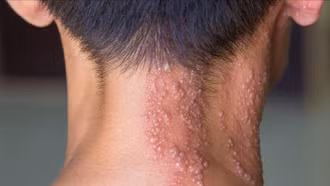 Liệt mặt do zona: Biến chứng không thể xem nhẹ