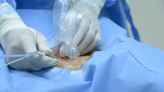 Bước đột phá điều trị hạch cổ tái phát sau mổ ung thư tuyến giáp bằng kỹ thuật đốt sóng cao tần