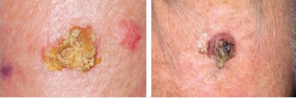 Khám vết sùi loét trên đỉnh đầu bất ngờ nhận kết quả ung thư ảnh 1