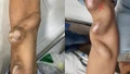 Cảnh báo suy thận ở người trẻ