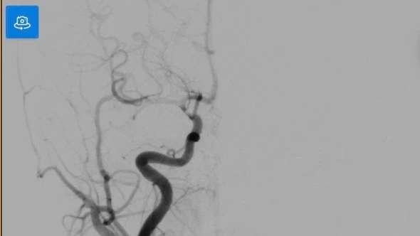 Cảnh báo đột quỵ não ở trẻ: Ca bệnh đánh thức sự chủ quan
