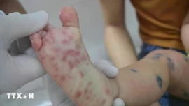 Thành phố Hồ Chí Minh ghi nhận 3 ca tử vong do tay chân miệng đầu tiên năm 2026