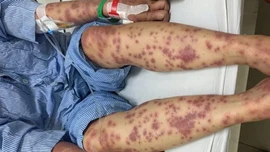 Nguy kịch vì dùng thuốc giảm cân, collagen không rõ nguồn gốc