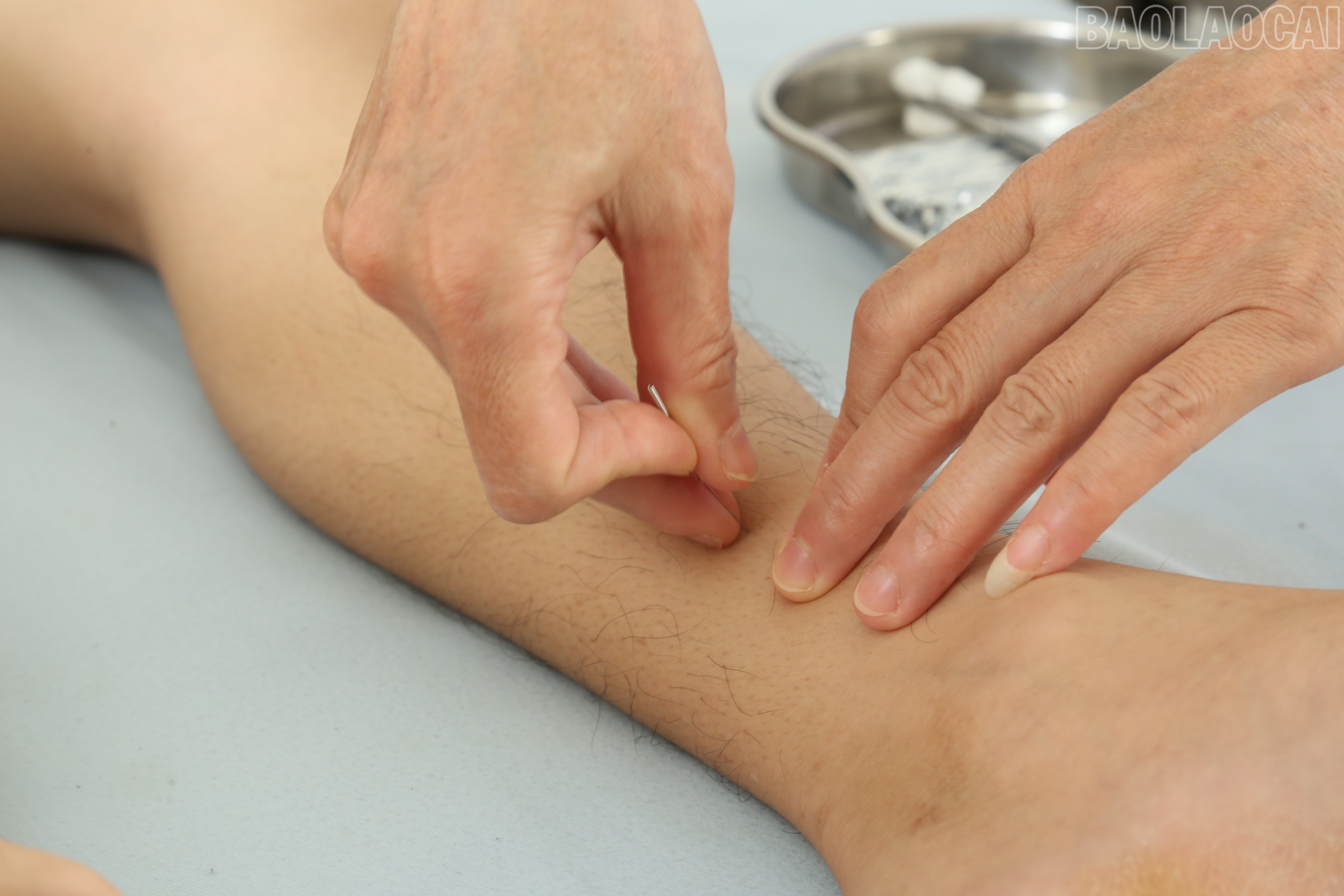 Phương pháp châm cứu giúp đả thông kinh lạc, tăng tuần hoàn máu. baolaocai-tr_img-1553.jpg