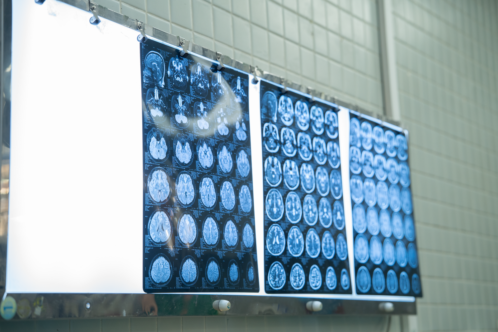 Kết quả chụp MRI tưới máu não và chụp mạch não số hóa xóa nền (DSA) ghi nhận hình ảnh điển hình của bệnh Moyamoya, một bệnh lý mạch máu não bẩm sinh.