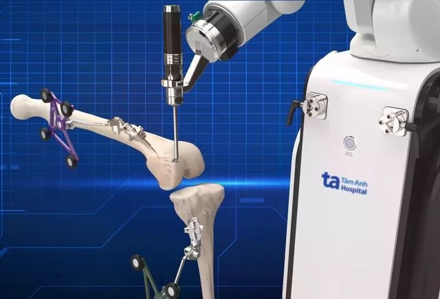 Robot CUVIS-Joint chủ động cắt xương thay khớp chuẩn xác từng milimet, giúp căn chỉnh trục chân tối ưu.