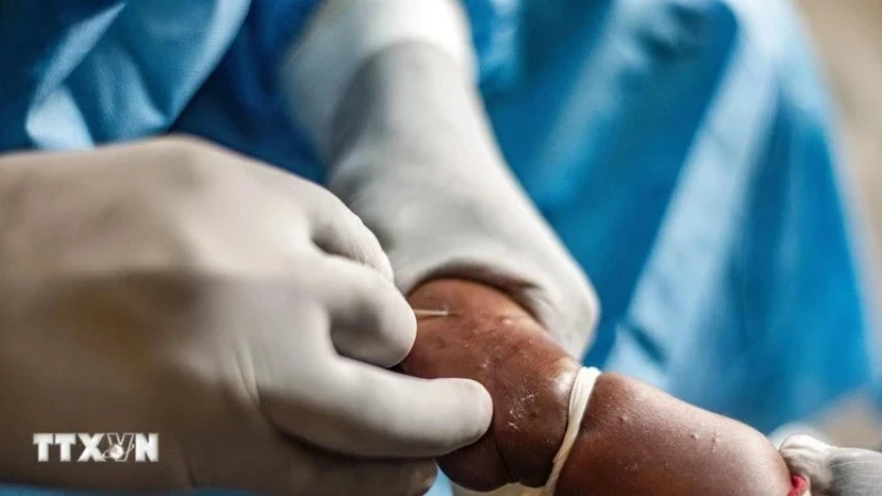 Nhân viên y tế điều trị cho bệnh nhân mắc đậu mùa khỉ tại Goma, Cộng hòa dân chủ Congo, ngày 15/8/2024.