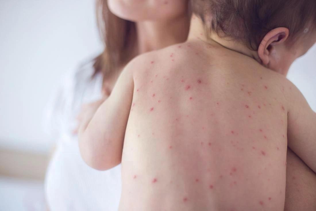 Nếu trong điều kiện không có biến chứng, các bậc phụ huynh có thể dễ dàng chăm sóc trẻ mắc sởi tại nhà. Nếu trong điều kiện không có biến chứng, các bậc phụ huynh có thể dễ dàng chăm sóc trẻ mắc sởi tại nhà.